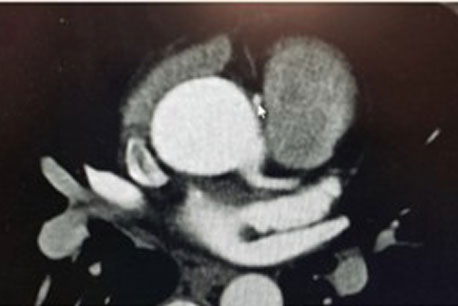 Interarterial course of right coronary artery as seen on computed tomography angiogram 